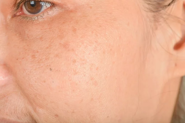Apa itu lentigo dan apa bedanya dengan bintik?
