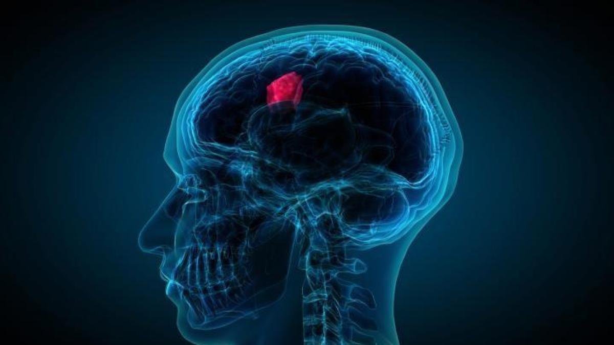 هل يمكن علاج الورم الأرومي الدبقي بزراعة الدماغ؟