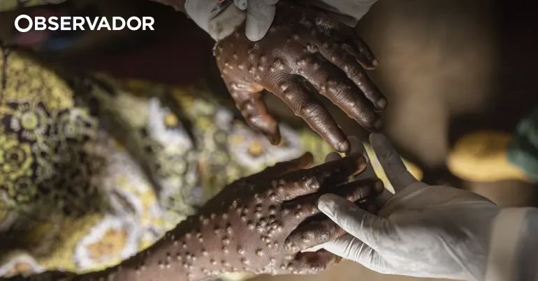 غينيا بيساو تؤكد أول حالة إصابة بالجدري - المراقب